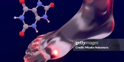 युरिक एसिडका बिरामीले के खानु हुन्छ, के खानु हुदैँन ? जान्नुहोस्